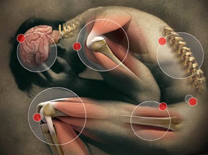 Chronic pain in survivors of critical illness: prevalence and associated psychological disorders